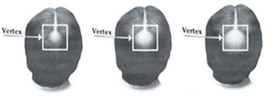 Vertex-hair-loss-minoxidil-treatment